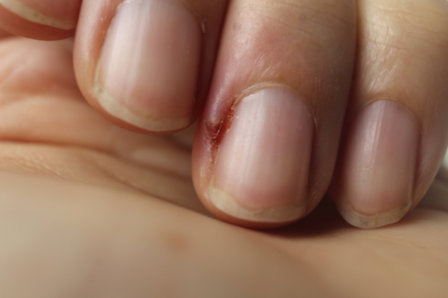 Riss neben dem Fingernagel